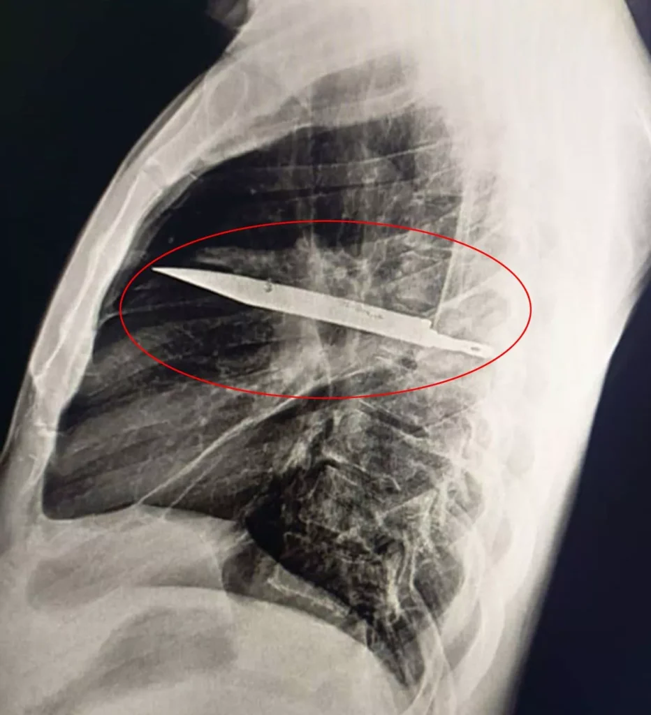 Doctors Find Large Knife Lodged In Man’s Chest For Eight Years After He Went To Hospital To Complain Of Sore Nipples