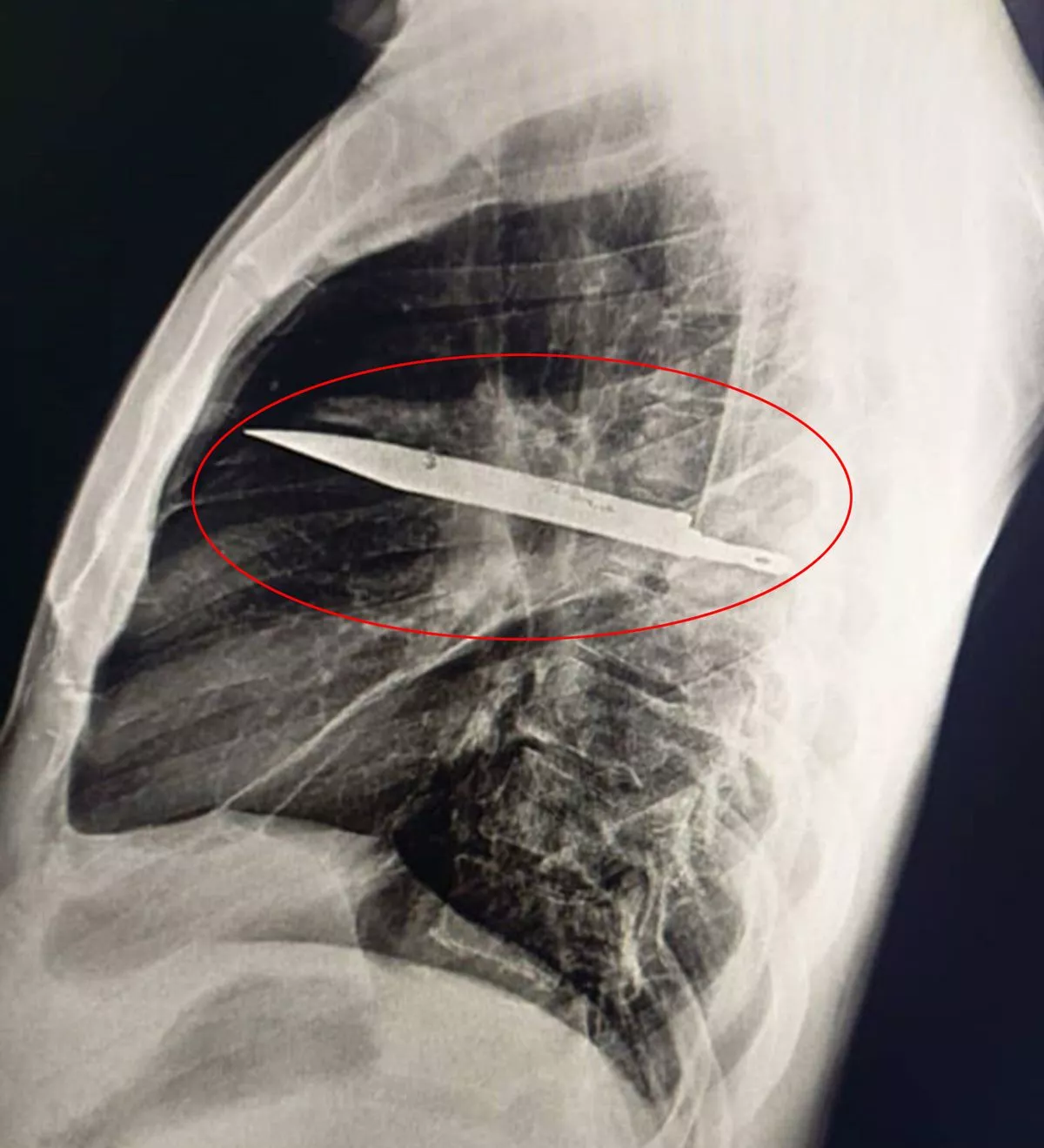 1 Shock As Man Lives With Knife Lodged In Chest For Eight Years 1755509015