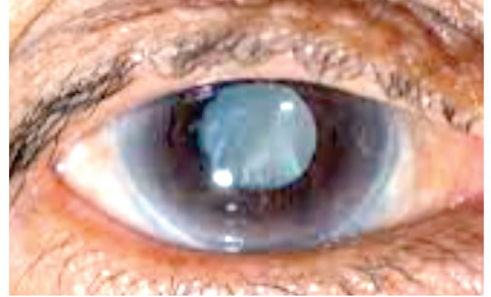 Disesed Eye