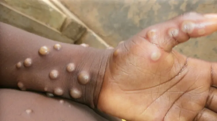 Mpox 2