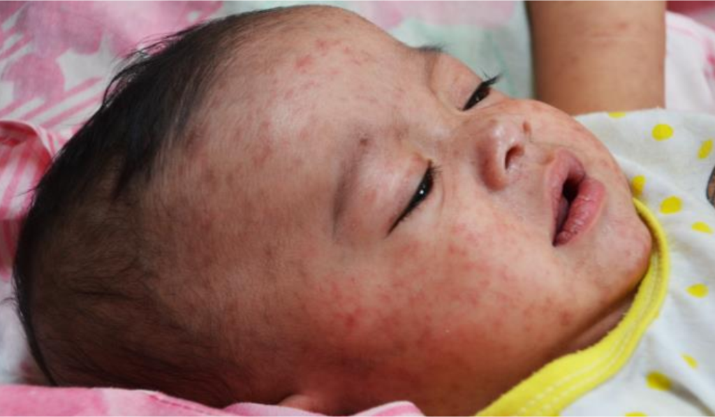 Child With Measles Used To Illustrate The Story Child With Measles Used To Illustrate The Story