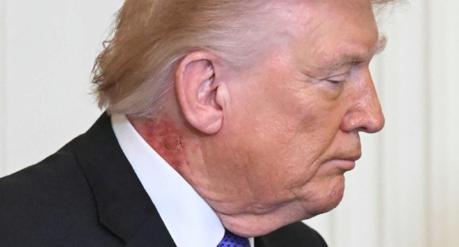 Trump Red Rash Trump Red Rash